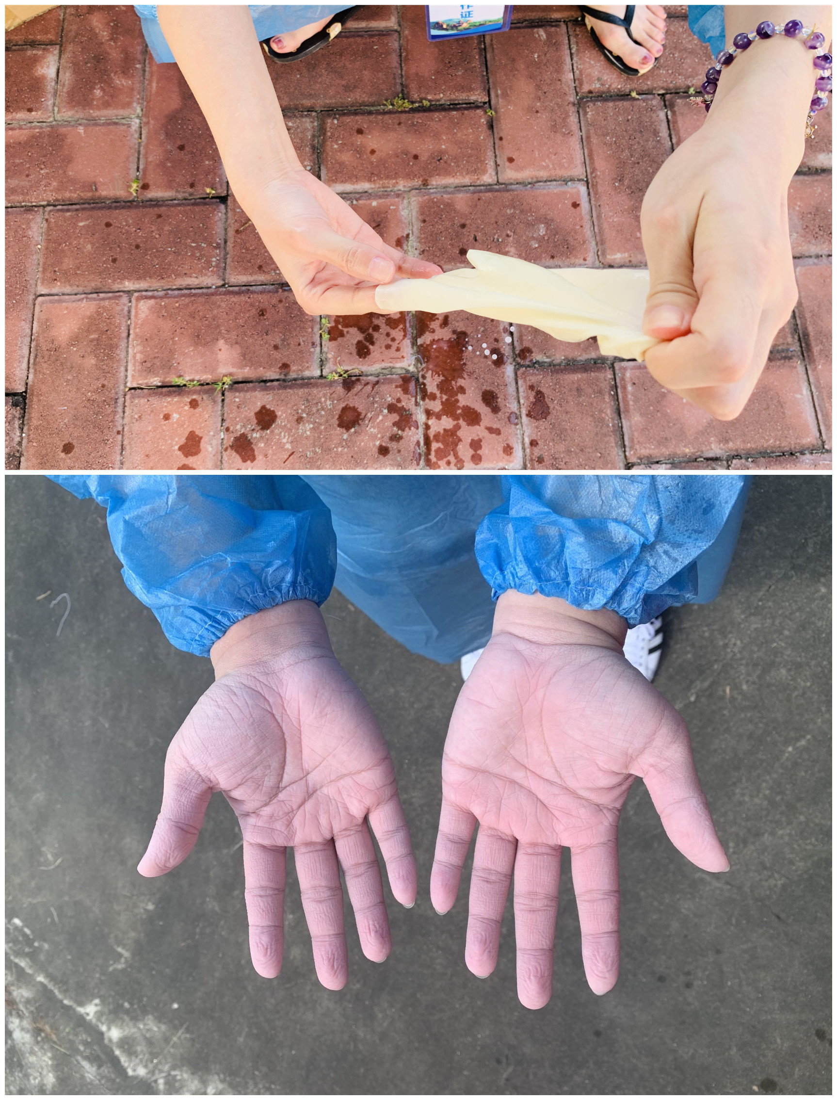 防疫一線工作人員的雙手：脫掉手套，在汗水和消毒液浸泡下發(fā)皺變白.jpg